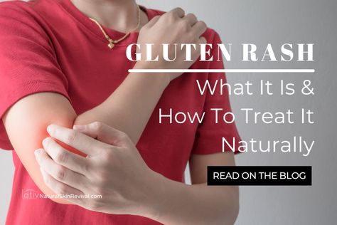 A gluten rash typically develops in middle aged people. It can be treated at home, but don't ignore this rash, it could be a sign of something more serious. We break it all down in our latest blog. Here are the early warning signs and how to treat naturally. Gluten Rash Pictures, Gluten Allergy Rash, Allergy Rash, Types Of Rashes, Rashes Remedies, Home Remedies For Skin, Gluten Allergy, Skin Bumps, Reading Food Labels