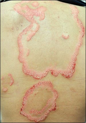 Photo Quiz: Generalized Annular Skin Lesions - American Family Physician Lesions Skin, Family Physician, Skin Lesions, Red Moles, James Jean, Skin Disorders, Medical Practice, Allergic Reaction, Keto Diet For Beginners