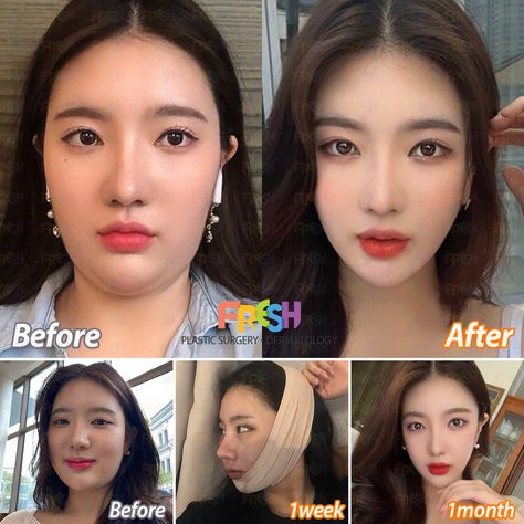 Get the Perfetc V-Line face! Double Chin Surgery, Chin Surgery, Kpop Plastic Surgery, Jaw Reduction Surgery, Face Plastic Surgery, Change Appearance, V Line Surgery, Plastic Surgery Fail, V Line Face