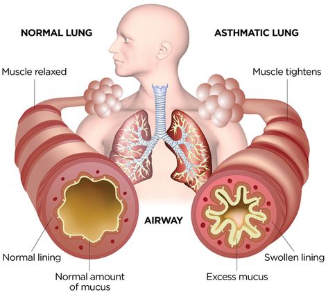 Asthma is a chronic disease characterized by recurrent attacks of breathlessness and wheezing, and occurs in people of all ages. It is the most common chronic disease among children. It currently affects about 339 million people. The strongest risk factors for developing asthma are exposure to indoor allergens such as house dust mites in bedding, stuffed furniture; pollution and pet dander; outdoor allergens such as pollens and moulds; tobacco smoke and chemical irritants in the workplace. What Is Asthma, Turmeric Health, Asthma Symptoms, Respiratory Infection, Asthma Attacks, Lung Disease, Shortness Of Breath, Weezer, Muscle Relaxer