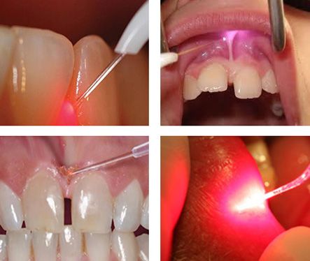 The 810nm and 980nm wavelength has been shown to have a significant Dental Laser, Dental Posts, Dental Posters, Laser Dentistry, Sign Board, Laser Therapy, Tooth Decay, Oral Hygiene, Oral Care