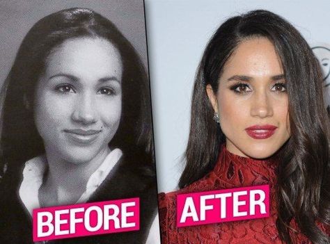 Meghan Markle Plastic Surgery – Nose Job, Teeth – before and after - Emmanuel's Blog Megan Markle Nose, Meghan Markle Nose Job, Meghan Markle Plastic Surgery, Meghan Markle Hair, Plastic Surgery Photos, Princess Meghan, Celebrity Plastic Surgery, Celebrities Then And Now, Nose Shapes