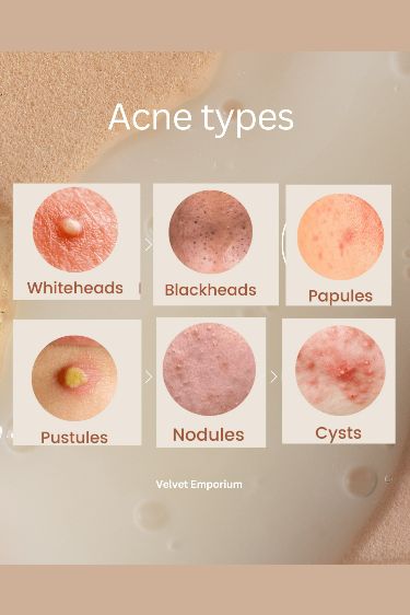 ACNE TYPES Acne Types And Causes, Face Acne Remedies, Papules Acne, Acne Aesthetic, Pustules Acne, Acne Types, Best Acne Scar Removal, Closed Comedones, Biology Project