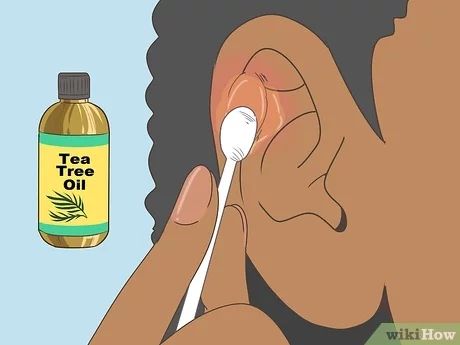 3 Ways to Heal Cartilage Piercing Bumps - wikiHow Cartilage Piercing Infection, Infected Ear Piercing, Tea Tree Cream, Piercing Bump, Tea Tree Oil Uses, Ways To Heal, New Piercing, Healing Essential Oils, Healing Ointment