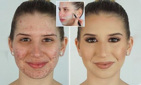 Make up artist covers acne using foundation and GREEN concealer #DailyMail Green Concealer How To Use, How To Use Green Concealer, Best Makeup For Acne, Acne Cover Up, Covering Acne, Green Concealer, Primer For Dry Skin, Acne Scaring, Corrective Makeup