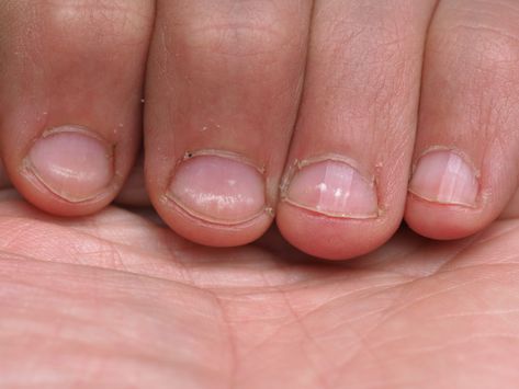 How To Get Rid Of White Spots On Nails, White Dots On Nails, White Spots On Toenails, White Spots On Nails, Knee Care, Nail White, Nails Brown, Fungal Nail, Nail Pictures