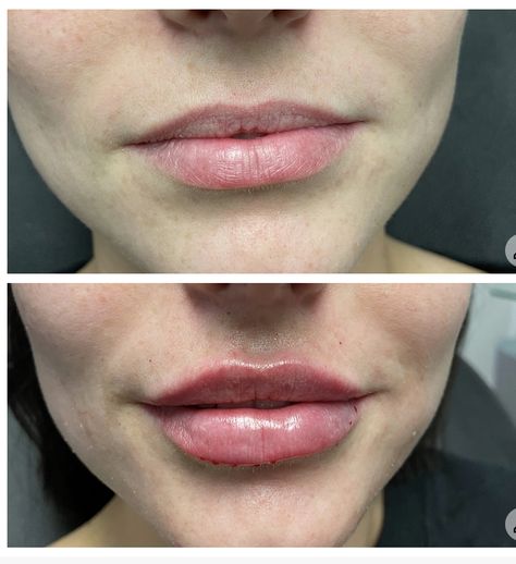 Lip Augmentation Lip Augmentation, Medical Aesthetics, Medical Aesthetic, Aesthetic Design, Ideas Style, Home Ideas, Medical, Lips, Style Inspiration