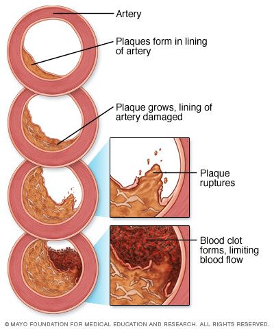 #Atherosclerosis is a process in which blood, fats such as cholesterol, and other substances build up on your artery walls. Eventually, deposits called plaques may form. The deposits may narrow — or block — your arteries. These plaques can also rupture, causing a blood clot. High Cholesterol Symptoms, Peripheral Artery, Sistem Saraf, Cholesterol Symptoms, Lower Blood Sugar Naturally, Cholesterol Medications, Cholesterol Remedies, Disease Symptoms, Hdl Cholesterol