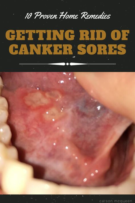 Find out how to get rid of canker sores using home remedies found in your kitchen! Say goodbye to these persistent wounds for good!  #cankersore #cankersoreremedy #howtogetridofcankersore #cankersoreremedytongue ##cankersoreremedymouth #howtogetridofcankersorefast Home Remedy For Mouth Ulcers, Cold Sore Inside Mouth Remedy, Sore Gums Remedy, Canker Sore Remedies, Canker Sore On Tongue, Cold Sore Remedy Overnight, Canker Sore Relief, Ulcer Remedies Mouth, Canker Sore Remedy