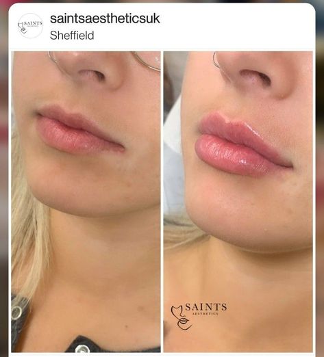 Lip Styles Filler, M Shaped Lips Before And After, Lip Filler Shapes Chart, Lip Goals Filler, Lip Filler M Shaped Lips, Lip Filler Transformation, Kendall Jenner Lip Fillers, Lips Filer Shape, Downturned Lips Filler