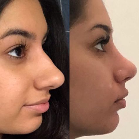 Bulbous Tip Rhinoplasty Before After, Rhinoplasty Bulbous Tip, Bulbous Tip Rhinoplasty, Tip Rhinoplasty, Kpop Plastic Surgery, Nose Ideas, Jaw Reduction Surgery, Nose Surgery Rhinoplasty, V Line Surgery