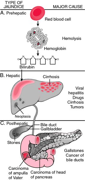 prehepatic jaundice - definition of prehepatic jaundice by Medical dictionary Jaundice Notes, Medical Terminology Notes, Jaundice Symptoms, Notes For Medical Terminology, Allopathic Medicine List, Gilbert's Syndrome, Medical Dictionary, Summer Health, Basic Anatomy And Physiology