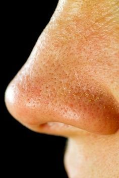 Solutions For Large Pores - What Causes Pores to Enlarge? To Remove Blackheads, Remove Blackheads, Beauty Remedies, Large Pores, Homemade Face, Beauty Recipe, Homemade Beauty Products, Blackhead Remover, Skin Tips