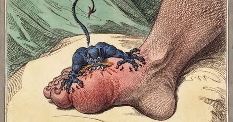 I’ve never experienced a gout attack, but if common graphical representations are to be believed, it feels like there are shards of br... Kwas Moczowy, James Gillray, Uric Acid Levels, Restless Legs, Restless Leg Syndrome, Uric Acid, A4 Poster, Natural Treatments, Chronic Pain