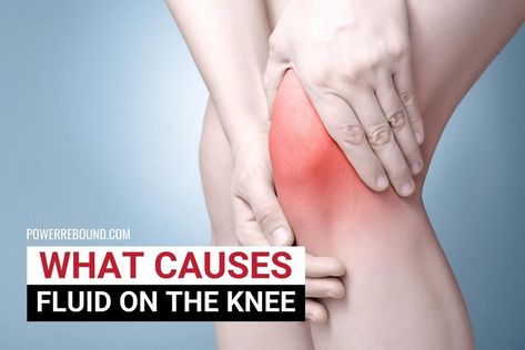 Fluid On The Knee, Bursitis Knee, Parts Of The Knee, Core Exercises For Women, Sore Knees, Swollen Knee, Joints Pain Remedy, Knee Pain Exercises, Synovial Fluid