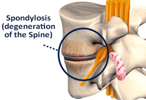 Low Back Pain Due to Lumbar Spondylosis, Degenerative Joint Disease affecting Lower Lumbar Vertebrae, Disc, And Related Nerve Root. Spinal Anatomy, Lumbar Spondylosis, Lumbar Vertebrae, Spinal Degeneration, Lumbar Lordosis, Hamstring Muscles, Cervical Spondylosis, Spinal Column, Chronic Lower Back Pain