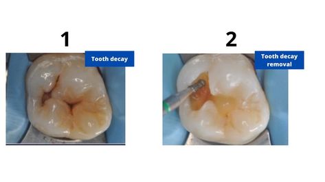 Learn all about back tooth cavity filling, including types of fillings, the procedure, how long they can last, and how to properly care for them. Prevent filling failure with our expert tips and advice. Cavity Filling, Tooth Cavity, Tooth Filling, Teeth Care, Tooth Decay, Tips And Advice, Cavities