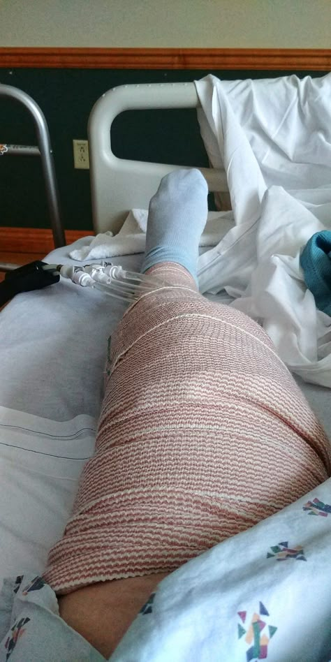 my "bee's knee" just got replaced yesterday. looking forward to living life again. Hospital Admit, Iphone Screen Repair, Hospital Photography, Joker Hd Wallpaper, Call With Boyfriend Screen, Leg Injury, Video Call With Boyfriend Screen, Video Call With Boyfriend, Army Pics