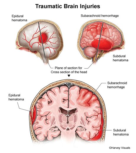 traumatic brain injury diagram Human Brain Anatomy, Traumatic Brain Injuries, Subarachnoid Hemorrhage, Brain Injuries, Brain Anatomy, Personal Injury Lawyer, Human Brain, Personal Injury, Toronto Ontario