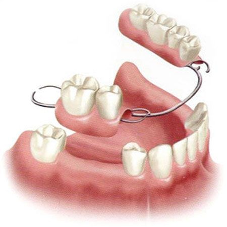 Partial Dentures, a Viable Alternative to Dental Implants? Denture Adhesive, Tooth Repair, Dental Implants Cost, Partial Dentures, Front Teeth, Tooth Replacement, Perfect Teeth, Missing Teeth, Teeth Implants