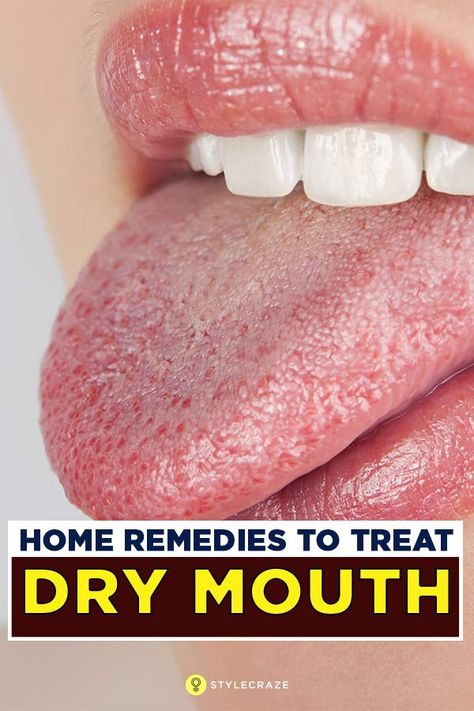 Remedies For Dry Mouth, Tongue Health, Dry Mouth, Cold Sores Remedies, Different Diets, Natural Sleep Remedies, Natural Cold Remedies, Natural Cough Remedies, Cold Home Remedies