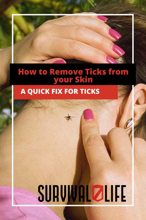 How to Remove Ticks from your Skin How To Remove A Tick From A Human, Tick Removal Human, Neck Headache, Cleaning Tips Tricks, Living Off The Grid, Tick Removal, Tick Bite, Cleaning Painted Walls, Deep Cleaning Tips