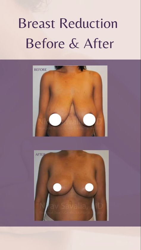 Click the link to see more of our transformstions! Breast Reduction Exercise At Home, Breast Lift Before And After, Breast Lift Surgery Before And After, Breast Reduction Before And After, Breast Reduction Exercise, Baby Led Weaning Lunch Ideas, Mummy Makeover, Dear Myself, Breast Lift Surgery