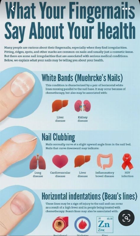 Pitted Nails, Clubbing Nails, Nail Health Signs, Iridology Chart, Nail Room Ideas, Vitamin B 12, Nail Problems, Nail Infection, Tongue Health