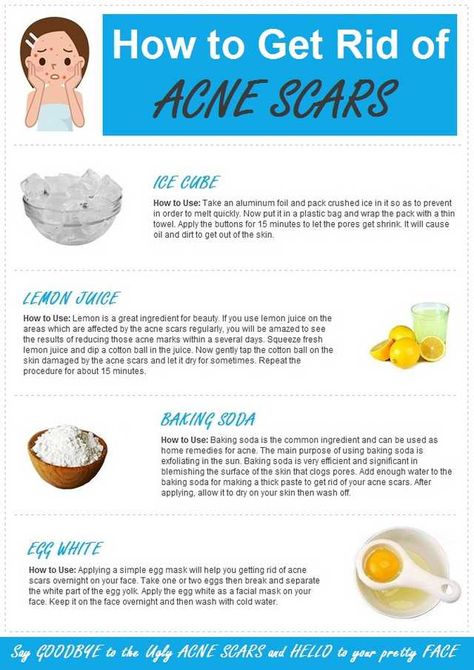 Chest Acne, Skin Care Routine For 20s, Diy Acne, Get Rid Of Acne, Rid Of Acne, Natural Acne, Home Remedies For Acne, Types Of Acne, Acne Scar Removal