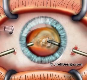 Vitrectomy Surgery, Opthalmic Technician, Eye Health Facts, Retina Surgery, Eye Retina, Medical Illustrations, Eye Anatomy, Eye Sight Improvement, Medical Terminology