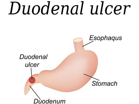 Home remedies for duodenitis can include usage of banana, honey, carrot juice, raw cabbage, food containing high fibre such as oat, barley, lentils. Aloe Vera For Sunburn, Remedies For Dry Mouth, Pinkeye Remedies, Raw Cabbage, Banana Honey, Home Remedies For Allergies, Home Remedies For Warts, Oily Skin Remedy, Warts Remedy