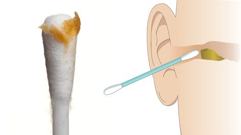 Ear Specialists Explain 6 Reasons to Stop Cleaning Ears With Cotton Buds » Ear Congestion, Clogged Ears, Ear Pressure, Bad Headache, Cleaning Your Ears, Coconut Health Benefits, Nasal Spray, Benefits Of Coconut Oil, Sinus Infection