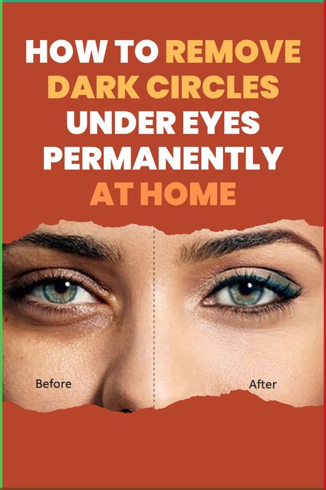 Discover quick and effective ways to remove dark circles under your eyes naturally and permanently at home! From DIY remedies to easy tips, these solutions can help reduce dark circles overnight—even in just 1 day. Perfect for those looking to brighten their eyes without costly treatments. Learn the best natural ingredients, like cucumber, aloe vera, and tea bags, to reduce puffiness and lighten dark circles for a refreshed look! Wrinkles Under Eyes, 6 Hours Of Sleep, Anti Aging Remedies, Wrinkle Remedies, Antiaging Skincare, Under Eye Wrinkles, Remove Dark Circles, Dark Circles Under Eyes, Reduce Dark Circles