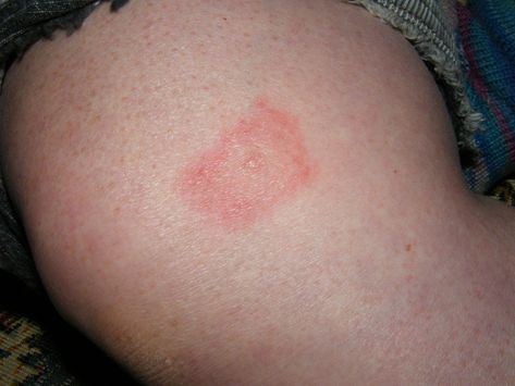 How to Identify the 10 Most Common Bug Bites in North America Spider Bites Pictures, Mthfr C677t, Ant Bites, Bug Spray Recipe, Wasp Stings, Bug Bite, Tick Bite, Spider Bites, Essential Oils Herbs