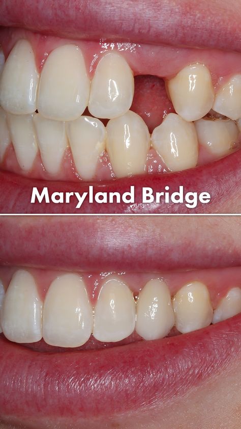 Tooth Bridge, Natural Wrinkle Remedies, Wisdom Tooth Extraction, Wrinkle Remedies, Dental Bridge, Teeth Implants, Tongue Health, Dental Services, Cosmetic Dentistry