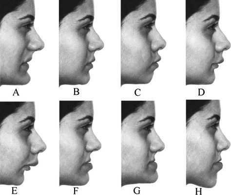 Introduction Improved facial esthetics can be fully achievable only if facial preferences of the treated group are known. We hypothesized that facial profile perception and preferences could be inf… Facial Deformity, Facial Harmony, Facial Profile, Facial Esthetics, Constipation Relief, Shape Of You, Improve Digestion, Digestive Health, Herbal Remedies