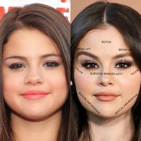 Celebrity Before And After Surgery, Liquid Facelift, Plastic Surgery Fail, Face Fillers, Plastic Surgery Gone Wrong, Face Surgery, Celebs Without Makeup, Facial Fillers, Makeup Before And After