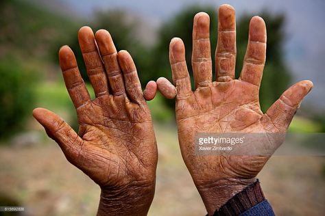 Close-up of hands with polydactyly syndrome and flexion deformities of fingers of a patient with extra toe and extra chromosome 13, known as trisomy 13, or Patau syndrome on May 3, 2009 in Atlas Mountains, Morocco. In that small mountainous village, all the family members have six fingers Patau Syndrome, Six Fingers, Life Drawing Reference, Healing Hands, Atlas Mountains, Life Drawing, Drawing Reference, Family Members, Morocco