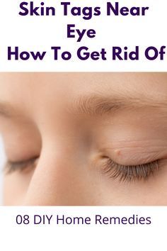 Skin Tags On Face, Warts On Face, Home Remedies For Warts, Remove Skin Tags Naturally, Warts Remedy, Home Remedies For Skin, Tag Remover, Get Rid Of Warts, Dry Skin Remedies