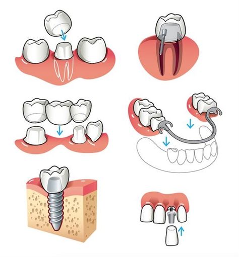 Dentaltown - A dental prosthesis is an intraoral (inside the mouth) prosthesis used to restore (reconstruct) intraoral defects such as missing teeth, missing parts of teeth, and missing soft or hard structures of the jaw and palate. Prosthodontics is the dental specialty that focuses on dental prostheses. Dental Assistant Study, Dental Images, Dental Posters, Dental Implants Cost, Dental Fun, Dental Facts, Dental Life, Dental Bridge, Dental Art