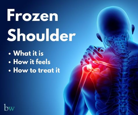 Frozen Shoulder (Adhesive Capsulitis) Frozen shoulder is a condition that causes pain in the shoulder, restricting movement What Is Frozen Shoulder, Frozen Shoulder Pain, Shoulder Surgery Recovery, Frozen Shoulder Exercises, Joints Anatomy, Shoulder Anatomy, Shoulder Rehab, Rotator Cuff Injury, Complex Regional Pain Syndrome