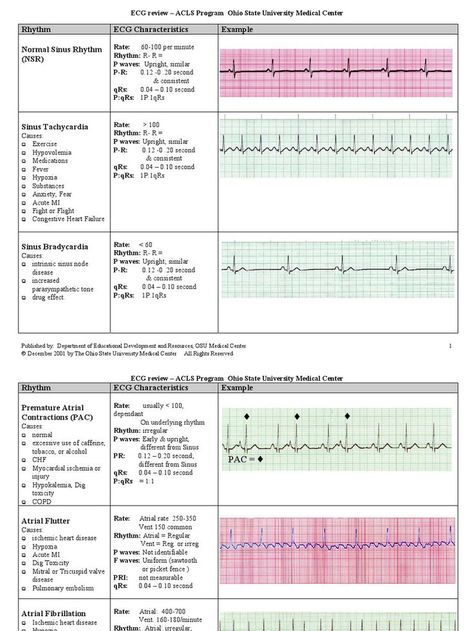 EKG examples of interpretation Ekg Nursing, Ekg Rhythms, Ekg Interpretation, Ecg Interpretation, Cardiac Rhythms, Heart Rhythm, Nursing Mnemonics, Cardiac Nursing, Nursing School Survival