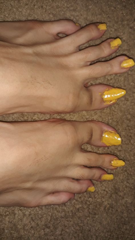 Brown Toenails, Yellow Nails And Toes, Pastel Yellow Toe Nails, Yellow French Tip Toes, Yellow Toe Nails, Stained Nails, French Tip Toes, Stripped Nails, Toe Nail Color