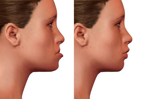 When the Jaws Don’t Align Correctly Some patients have significant over and under bites that cannot be corrected with orthodontics alone. This is when orthognathic surgery... Continue Reading Surgical Oncology, Corrective Jaw Surgery, Double Jaw Surgery, Orthognathic Surgery, Maxillofacial Surgery, Oral Maxillofacial, Bone Grafting, Jaw Surgery, Types Of Surgery