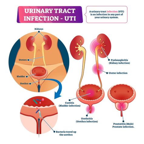 Too Much Estrogen, Icd 10, Respiratory Infection, Natural Antibiotics, Medical Coding, Health Planner, Bacterial Infection, Urinary Tract, Signs And Symptoms