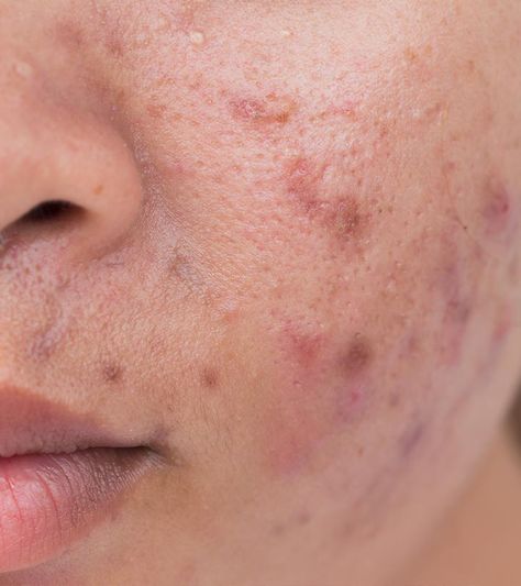 8 Myths About Acne That Are Making It Difficult For You To Get Rid Of It Sagging Skin Remedies, Dry Skin Causes, Face Care Products, Tips For Acne, Face Care Tips, Skin Peel, Natural Acne Remedies, Home Remedies For Acne, Get Rid Of Acne