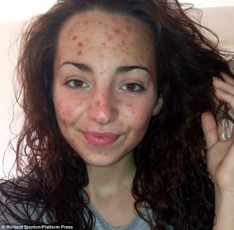 Brave and beautiful Samantha Wake, 20, with scarring on her face as a result of dermatillomania, a condition which means she compulsively picks at her skin until it is raw and bleeding. Skin Picking, Media Makeup, Scarring, Skin Disorders, Raw Beauty, Break Free, Dermatology, Skin Conditions, Face Skin