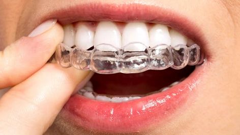 30 Things Brides Should Do 30 Days Before The Wedding - SHEfinds Orthodontist Aesthetic, Before And After Invisalign, Invisalign Attachments, Invisalign Hacks, Invisalign Tips, Behel Gigi, Orthodontics Marketing, Dental Clinic Ideas, Braces Before And After