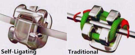 Self-ligating braces are braces that utilize little metal doors to hold the wires in place instead of elastic ties. Self-ligating braces are more comfortable than traditional braces. Fixed braces usually use brackets and wires which are attached to the teeth and through applying pressure the teeth should move into position. Braces Journey, Fixed Braces, Lingual Braces, Ceramic Braces, Braces Cost, Dental Posts, Facial Bones, Traditional Braces, Facial Nerve