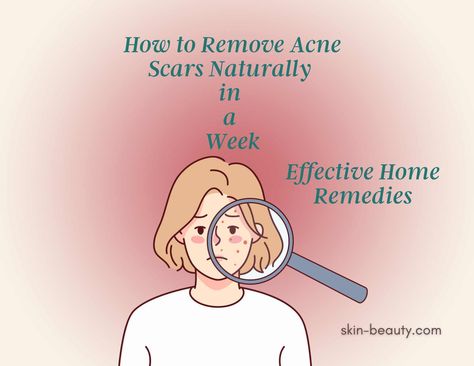 How to Remove Acne Scars Naturally in a Week: Effective Home Remedies Are you tired of acne scars stealing your confidence and affecting your social life? Worry no more! We have discovered effective home remedies, daily skincare routines, and dietary changes that can help you learn how to remove acne scars naturally in a week. Join us on this journey to regain your radiant skin and say goodbye to stubborn acne scars. How To Clear Acne Scarring, Best Acne Scar Removal, Scar Remedies, Face Mapping Acne, Stubborn Acne, Healing Essential Oils, Acne Face Mask, Oily Skin Acne, Severe Acne